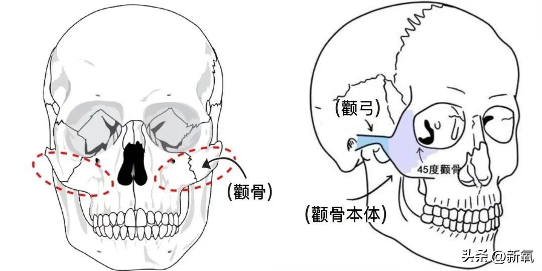 不用动骨头，就能让高颧骨“消失”，这样的大好事你会相信吗？