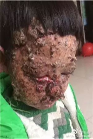 父母近亲结婚致男童患绝症满脸长黑色异物，生命周期仅剩不到一年